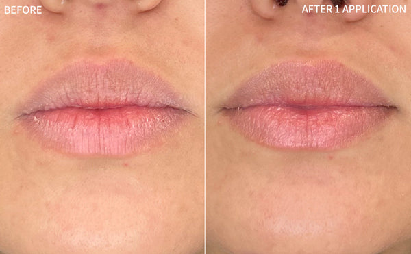 Dry Lips | 1 Application