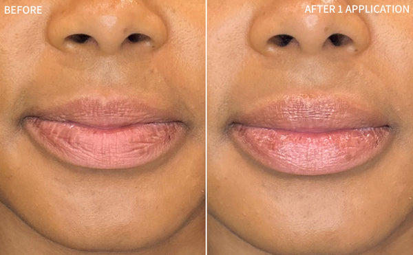 Dry Lips | 1 Application