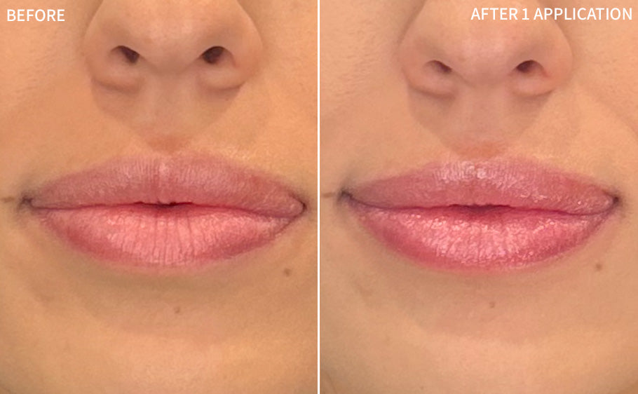Dry Lips | 1 Application