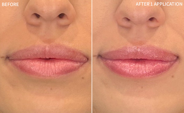 Dry Lips | 1 Application