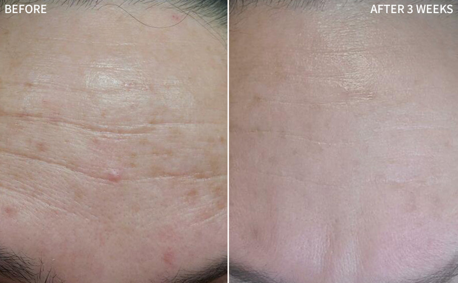 a compelling before and after image of a man with Hyperpigmentation on his forehead, the after image reveals the remarkable transformation after using the RescueMD serum for only 3 weeks
