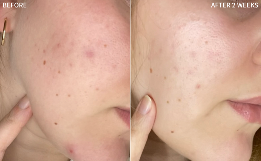 a powerful before-and-after image of a woman's face, showcasing the dramatic improvement in acne blemishes from the 'before' image to the clear and healed skin in the 'after' image after using the RescueMD serum diligently for 2 weeks