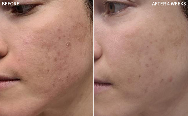 a before and after comparison of a woman's face affected with acne blemishes improved significantly after using the RescueMD serum only for 4 weeks