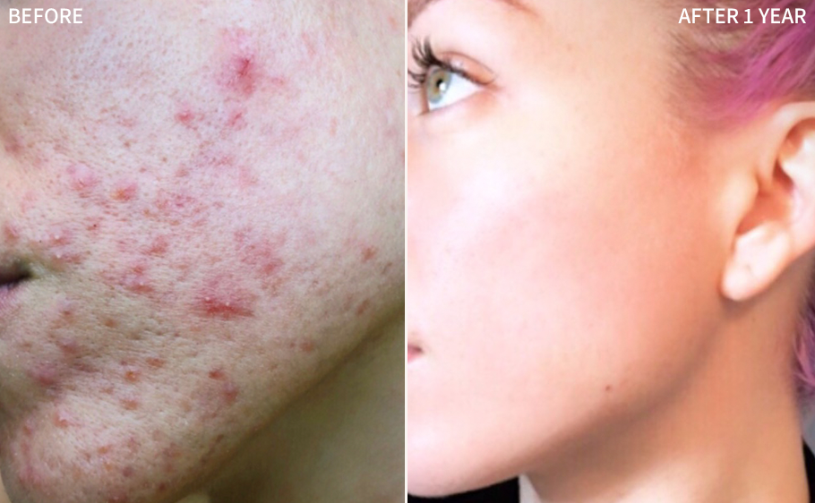 an eye-opening before and after comparison of a woman's face affected badly with acne blemishes, and a significantly improved and cleared face after using the RescueMD for 1 year