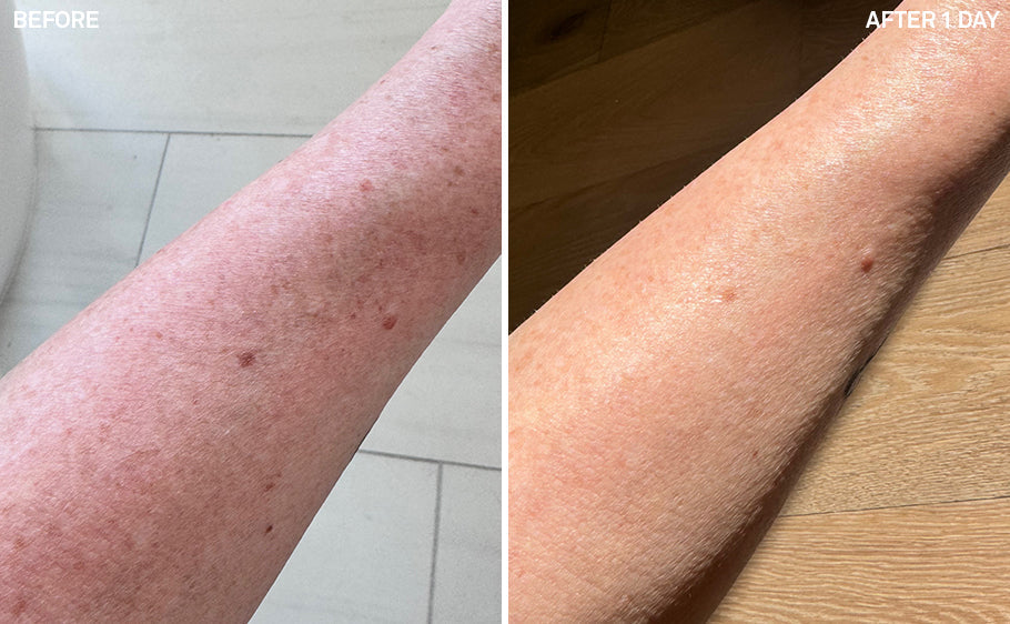Redness & Irritation | 24 Hours