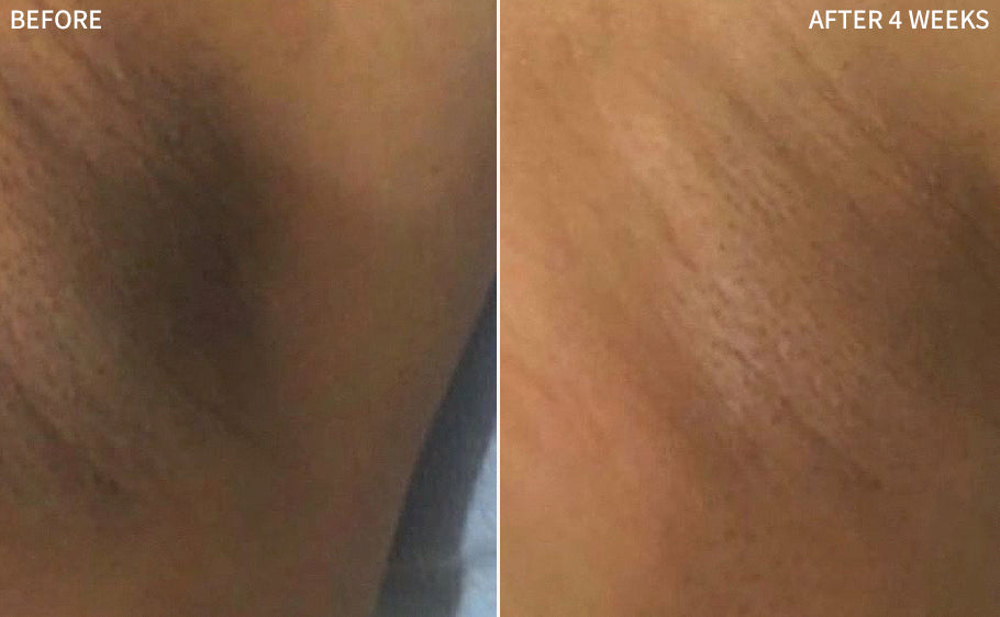 before and after comparison of armpit hyperpigmentation, showing significant healing with RescueMD serum