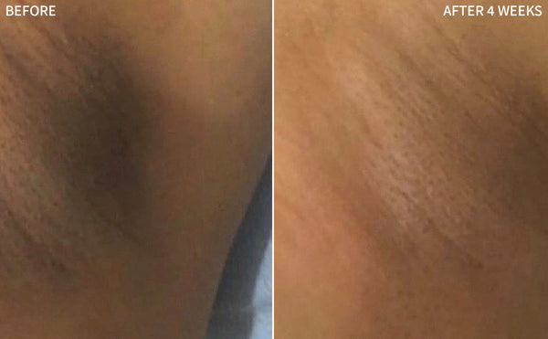 before and after comparison of armpit hyperpigmentation, showing significant healing with RescueMD serum