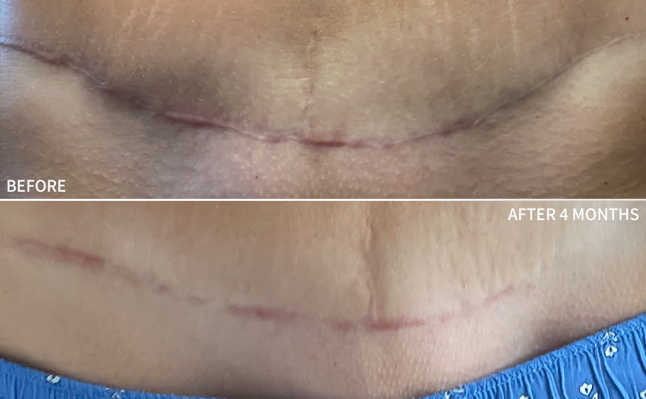 a before and after comparison of lower abdominal surgical scar improved significantly after using the RescueMD serum only for 4 months