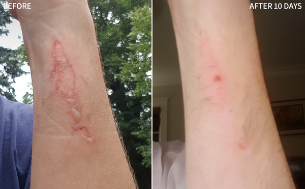 a clear before and after comparison of a man's wrist with a dark burn mark, and in the after image, it healed significantly after using the RescueMD only for 10 days