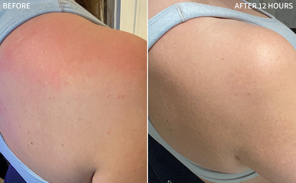 before and after images of a shoulder affected with sunburn having redness in the before image, and the after image has a really improved shoulder after 12 hours of using the RescueMD
