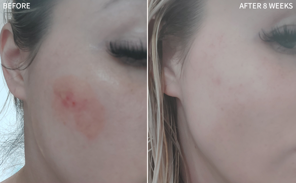 women having a wide dark red spot on her cheeks, healed quickly by using the RescueMD only for 8 weeks only