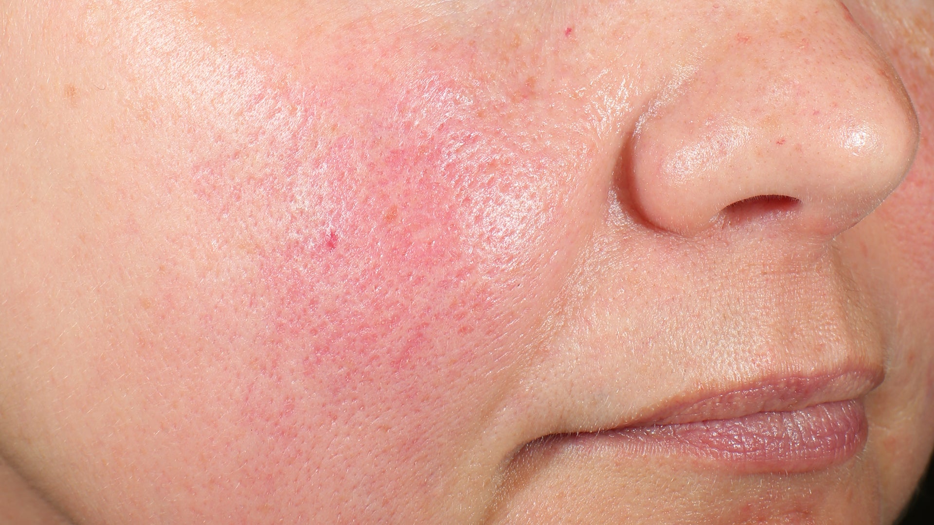 A Dermatologist Explains Your Skin Barrier