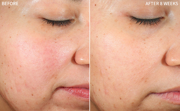closeup shot of a before and after comparison of a woman's face affected with redness in before and a good transformation after using the RescueMD serum for 8 weeks