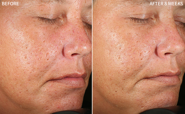 closeup shot of a before and after comparison of a woman's face affected with redness in before and a good transformation after using the RescueMD serum for 8 weeks