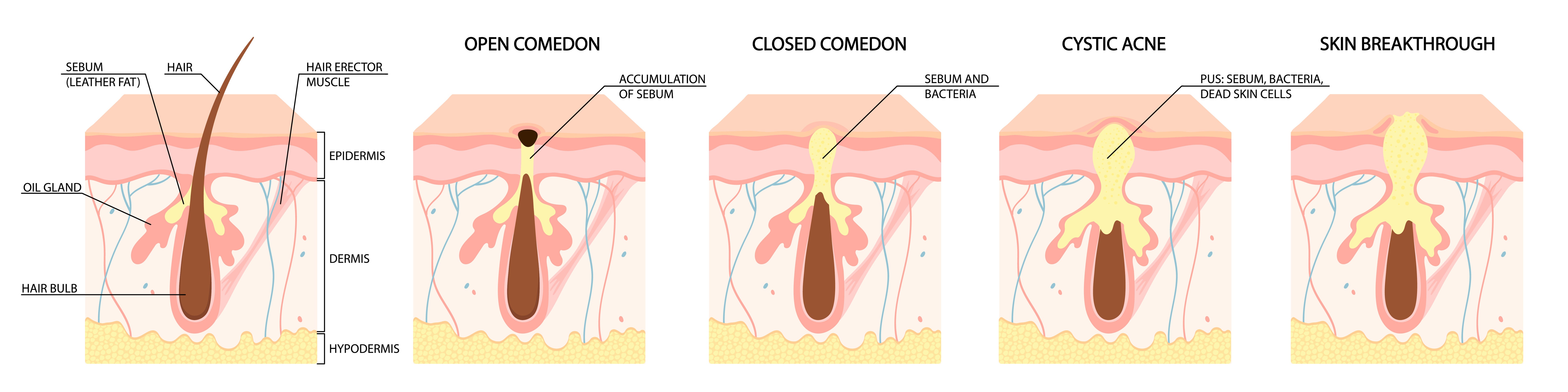 labeled diagram showing types of acne, including open comedones, closed comedones, inflammatory acne, and cystic acne etc