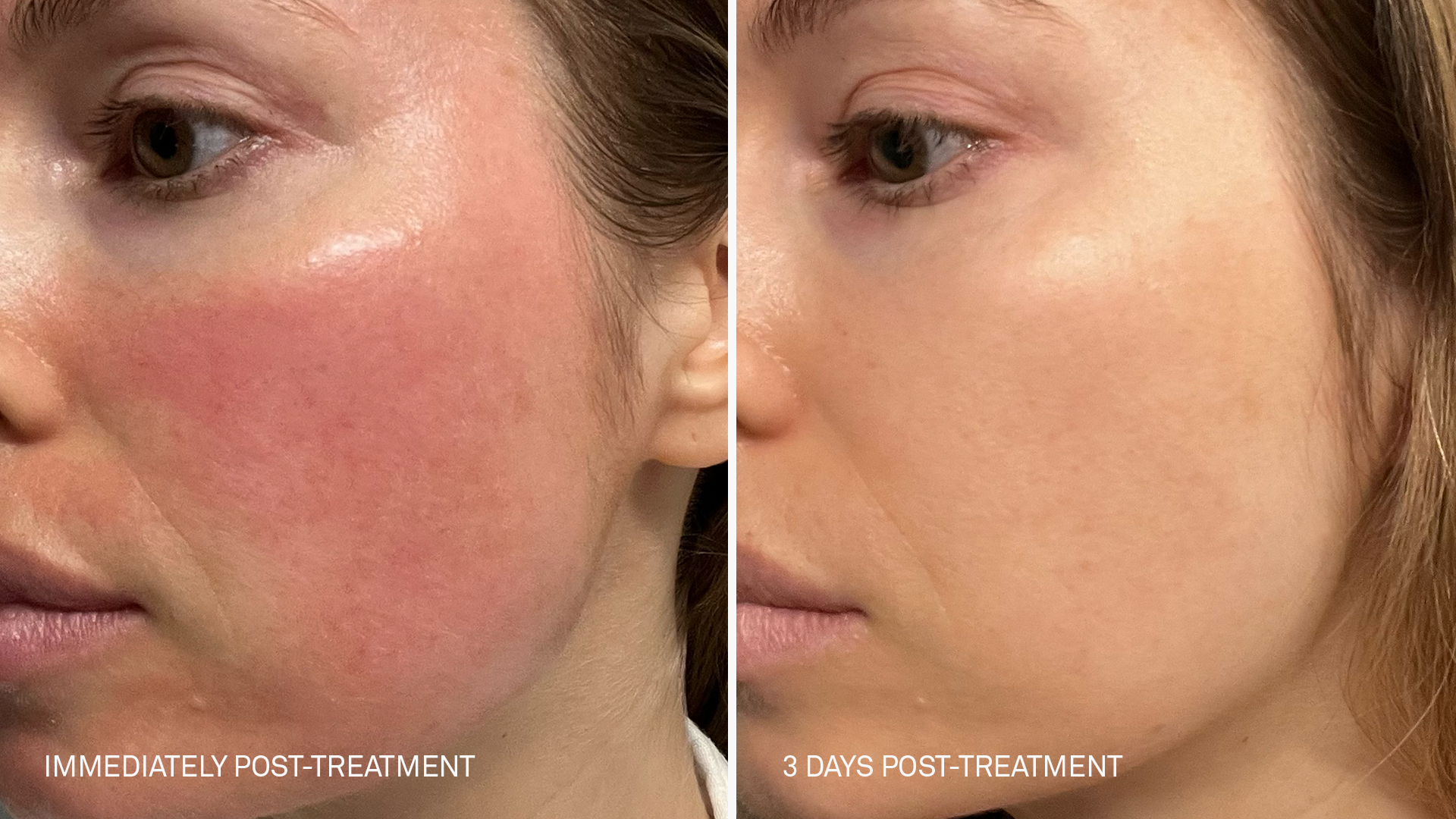 before and after images of a woman's face immediately after clear + brilliant treatment with redness, and 3 days post-treatment with the RescueMD serum