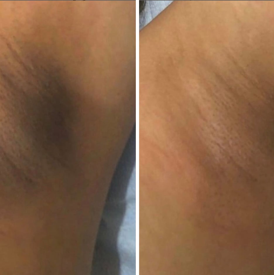 before and after comparison of armpit hyperpigmentation, showing significant healing with RescueMD serum