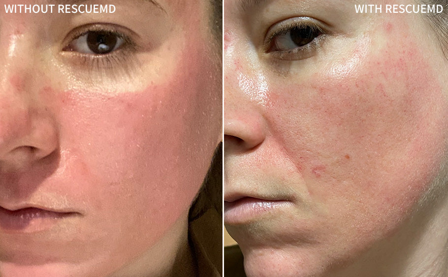 a image showcasing a before-and-after comparison of a woman's face undergoing Post-Microneedling treatment, with visible marks on her face in the before image. The after image reveals a remarkable improvement in just 3 days of using the RescueMD serum