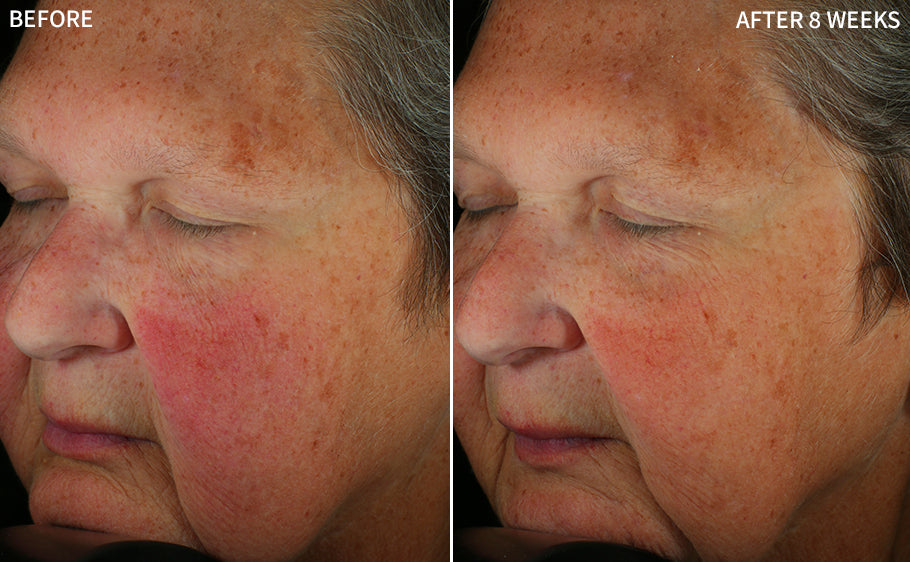 before and after images of an old women having redness on her cheeks after some treatment, and healed after using RescueMD serum only for 8 weeks