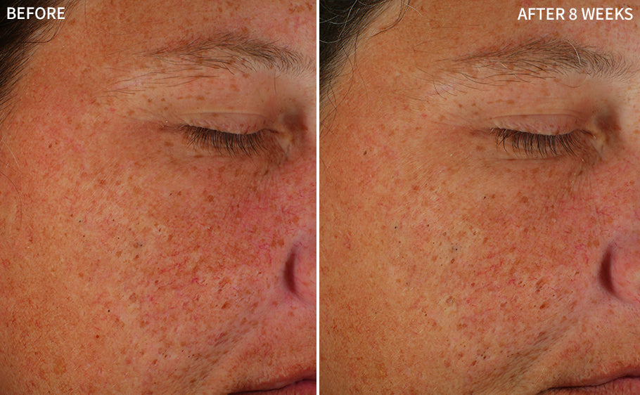 a close up side view of a woman's face having redness in before and a clearer face using the RescueMD serum for 8 weeks