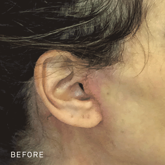 a GIF showing a woman's facelift scar near her ear with redness around it, followed by the redness disappearing after applying RescueMD serum