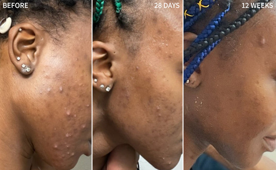 showcasing the complete treatment timeline for a woman's face, starting with the initial condition of prominent acne blemishes, indicating the need for effective treatment. The second image shows the progress after 4 weeks of using our serum, revealing visible improvements in the reduction of acne blemishes. The third and final image demonstrates the remarkable transformation after 12 weeks of consistent use of the RescueMD