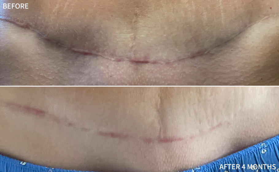 a before and after comparison of lower abdominal tummy tuck surgical scar improved significantly after using  the RescueMD serum only for 4 months