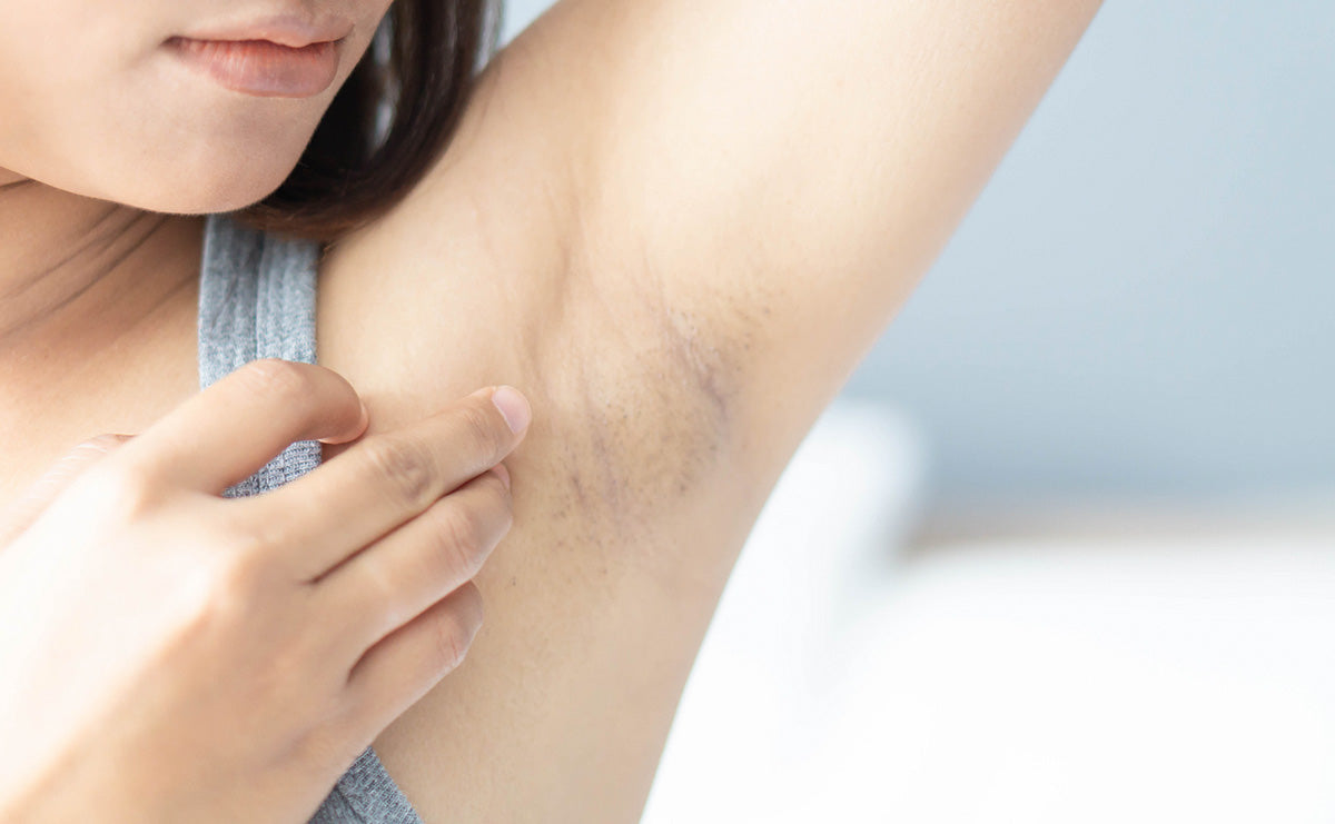 woman examining hyperpigmentation in her armpit