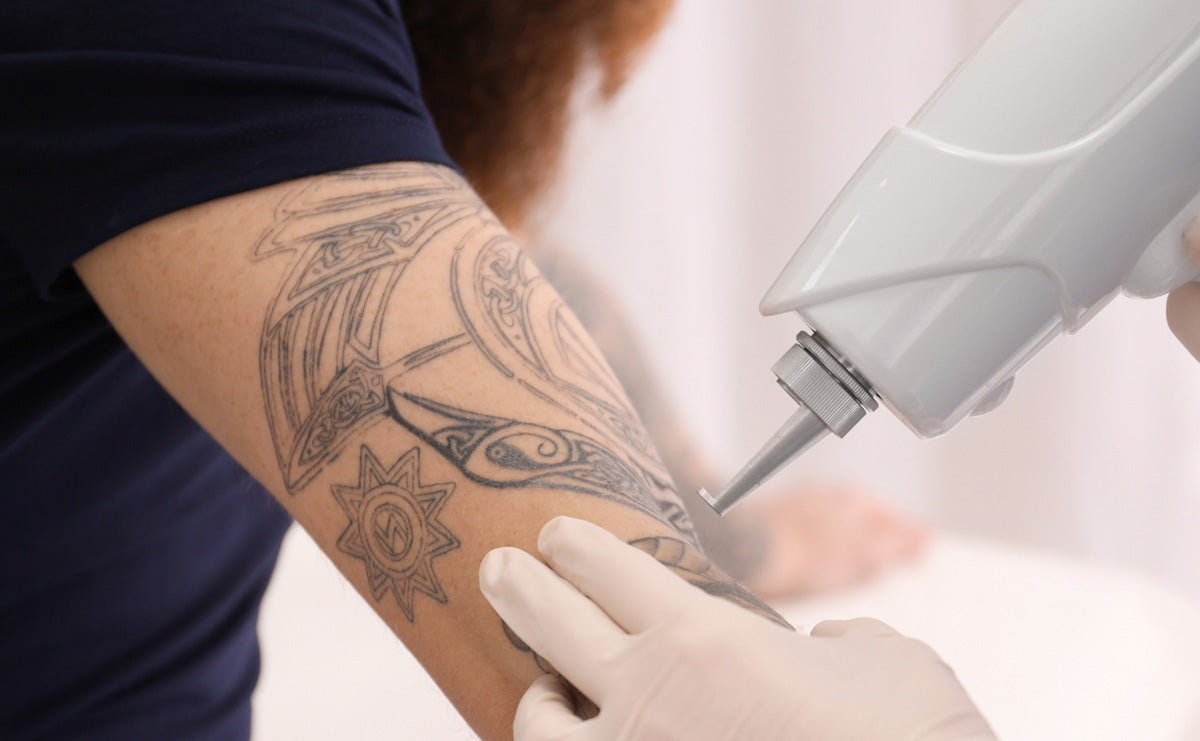 a woman with a big tattoo on her arm receiving tattoo removal treatment