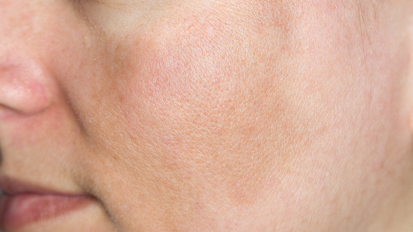 A Licensed Esthetician's Approach to Treating Hyperpigmentation & Melasma