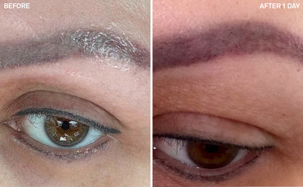 Eyebrow Ink Removal | 1 Day