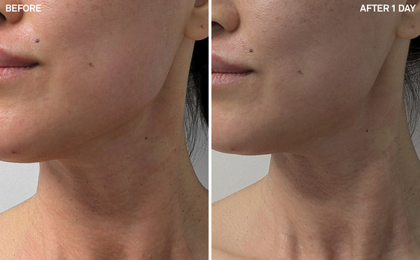 Microneedling | 1 Day