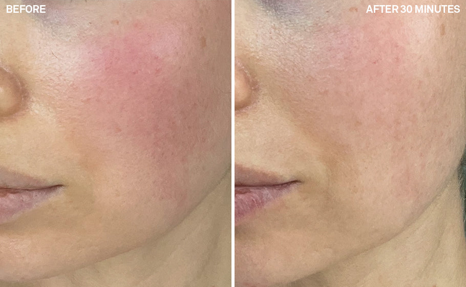 Rosacea | 30 Minutes