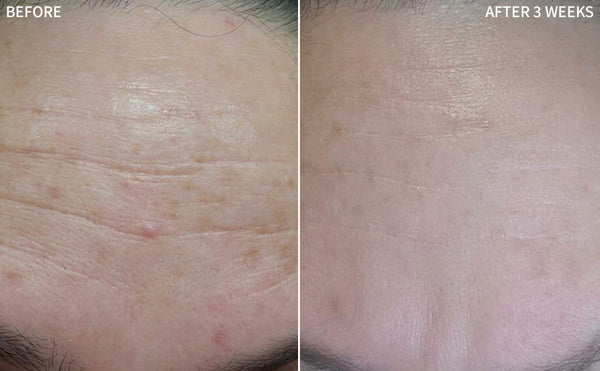 a compelling before and after image of a man with Hyperpigmentation on his forehead, the after image reveals the remarkable transformation after using the RescueMD serum for only 3 weeks
