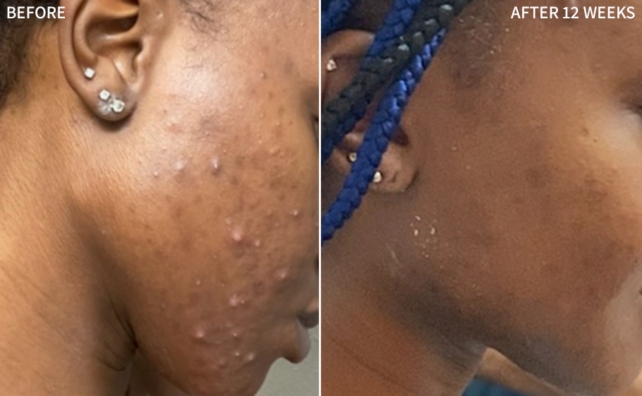 a compelling before-and-after image of a woman's face, showcasing the visible reduction of acne blemishes in the 'before' image and the healed and clear skin in the 'after' image after using the RescueMD serum consistently for 12 weeks