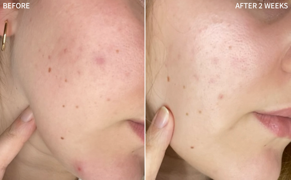 a powerful before-and-after image of a woman's face, showcasing the dramatic improvement in acne blemishes from the 'before' image to the clear and healed skin in the 'after' image after using the RescueMD serum diligently for 2 weeks