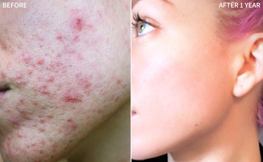 an eye-opening before and after comparison of a woman's face affected badly with acne blemishes, and a significantly improved and cleared face after using the RescueMD for 1 year 