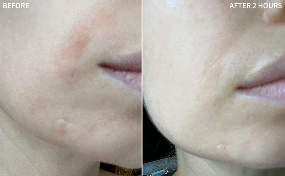 a before and after comparison of a woman's face affected with chemical Irritation, and its healed in after image only after using the RescueMD serum for 2 hours