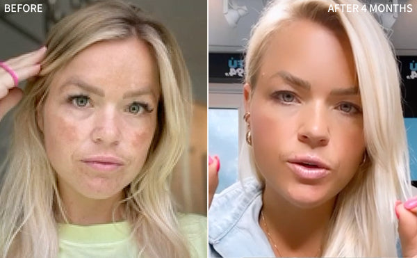 before and after image of a woman's face affected with Melasma, then the after image showcasing the remarkable transformation after 4 months of using the RescueMD serum