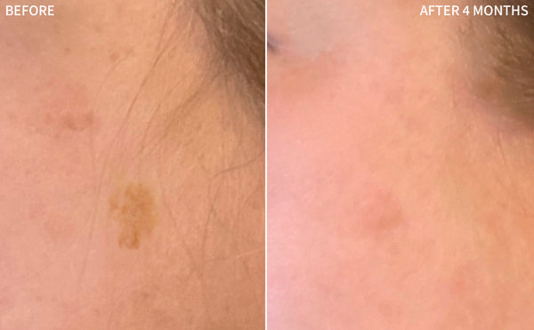 a comprehensive before and after comparison of a woman's face has Hyperpigmentation scars, and they recovered significantly after using RescueMD only for 4 months