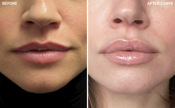 Lip Filler | 3 Days