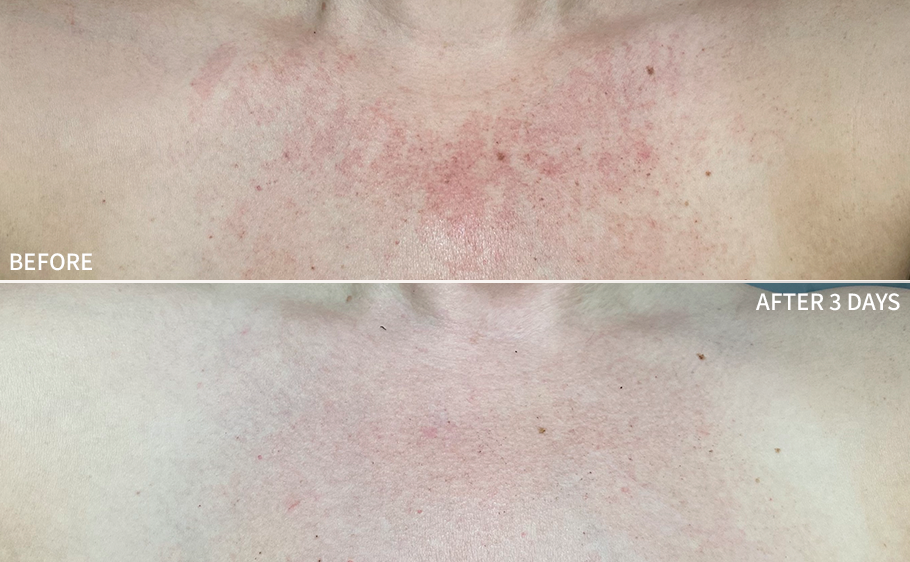 before an after comparison of Post-IPL redness effect on chest in the before image, and then significant improvement in the after image only after using the RescueMD serum for 3 days