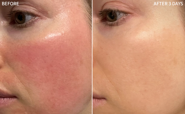 a before and after comparison of a woman's face, post-laser effect with visible redness, and an improved image only after using the RescueMD for 3 days
