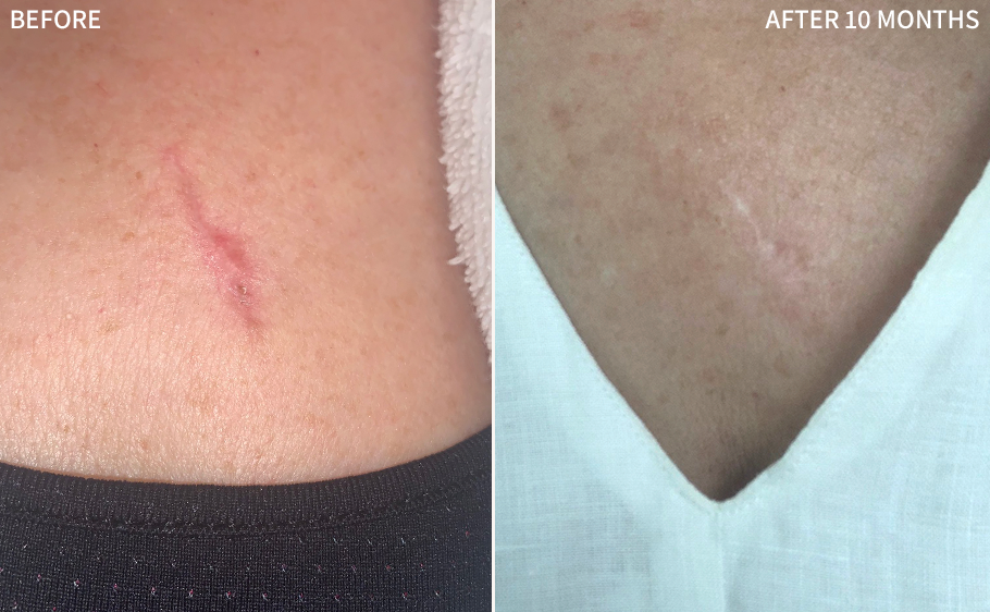 before and after images of a human chest having a surgical scar, healed and recovered significantly after using the RescueMD serum only for 10 months