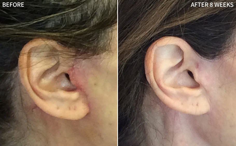 a clear before and after comparison of a woman's ear affected with a surgical scar,  healed significantly after using the RescueMD serum only for 8 weeks