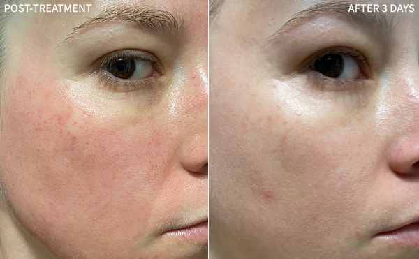 a image showcasing a before-and-after comparison of a woman's face undergoing Post-Microneedling treatment, with visible marks on her face in the before image. The after image reveals a remarkable improvement in just 3 days of using the RescueMD serum