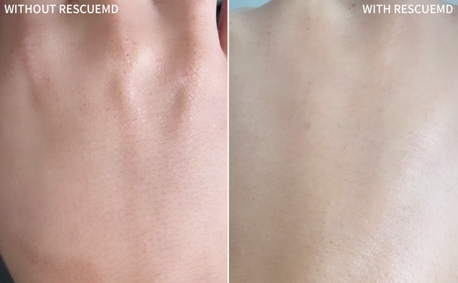 showing a comprehensive with and without comparison of a woman's hand with post-micro-needling + RF effect recovered dramatically with the RescueMD serum