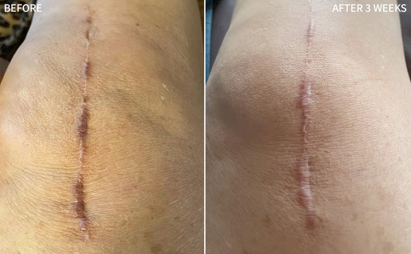 before and after images of a human knee having a big surgical scar, healed and recovered significantly after using the RescueMD serum only for 3 weeks