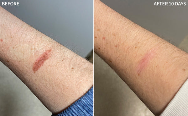 a comprehensive before and after comparison of a human wrist that burnt severely, healed and recovered significantly after using the RescueMD serum only for 10 days