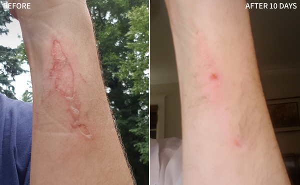 burn mark on arm
